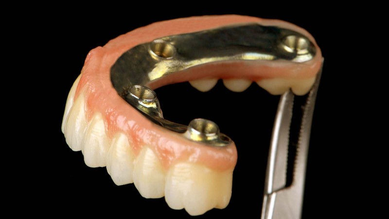 ibar con estructura de zirconio con cut-back vestibular